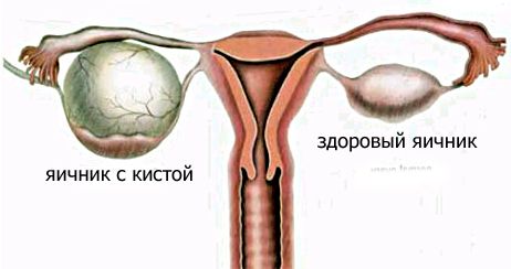 ovary-cyst 
